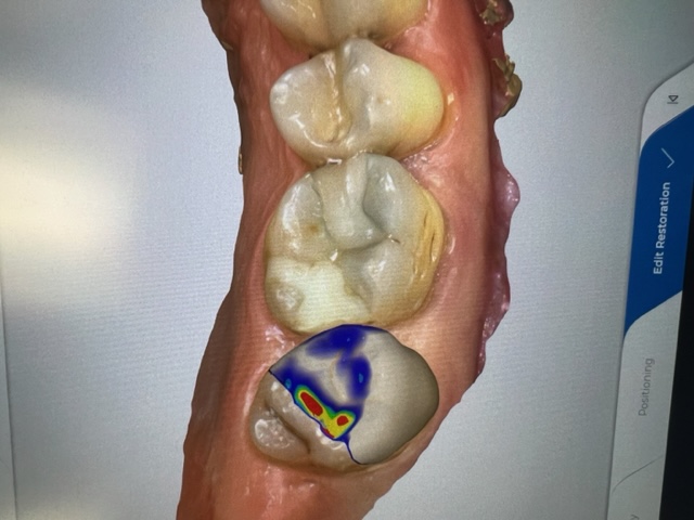 Tooth Restoration