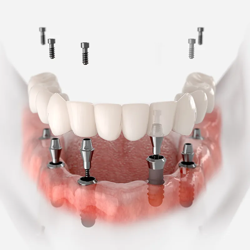 All on 4 Dental Implants Illustration