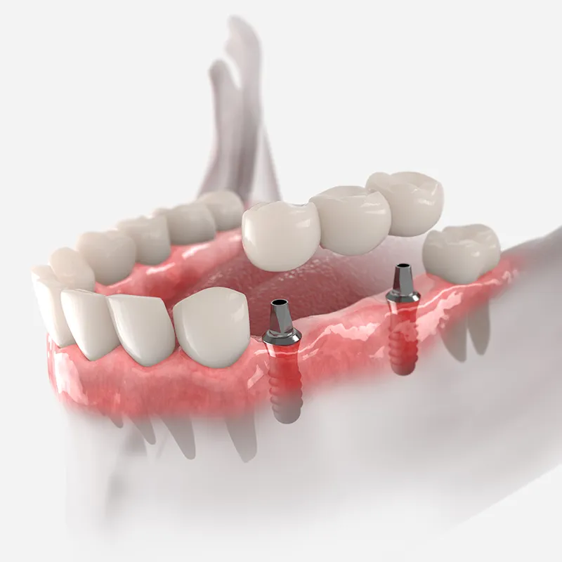 Dental Implant Bridge