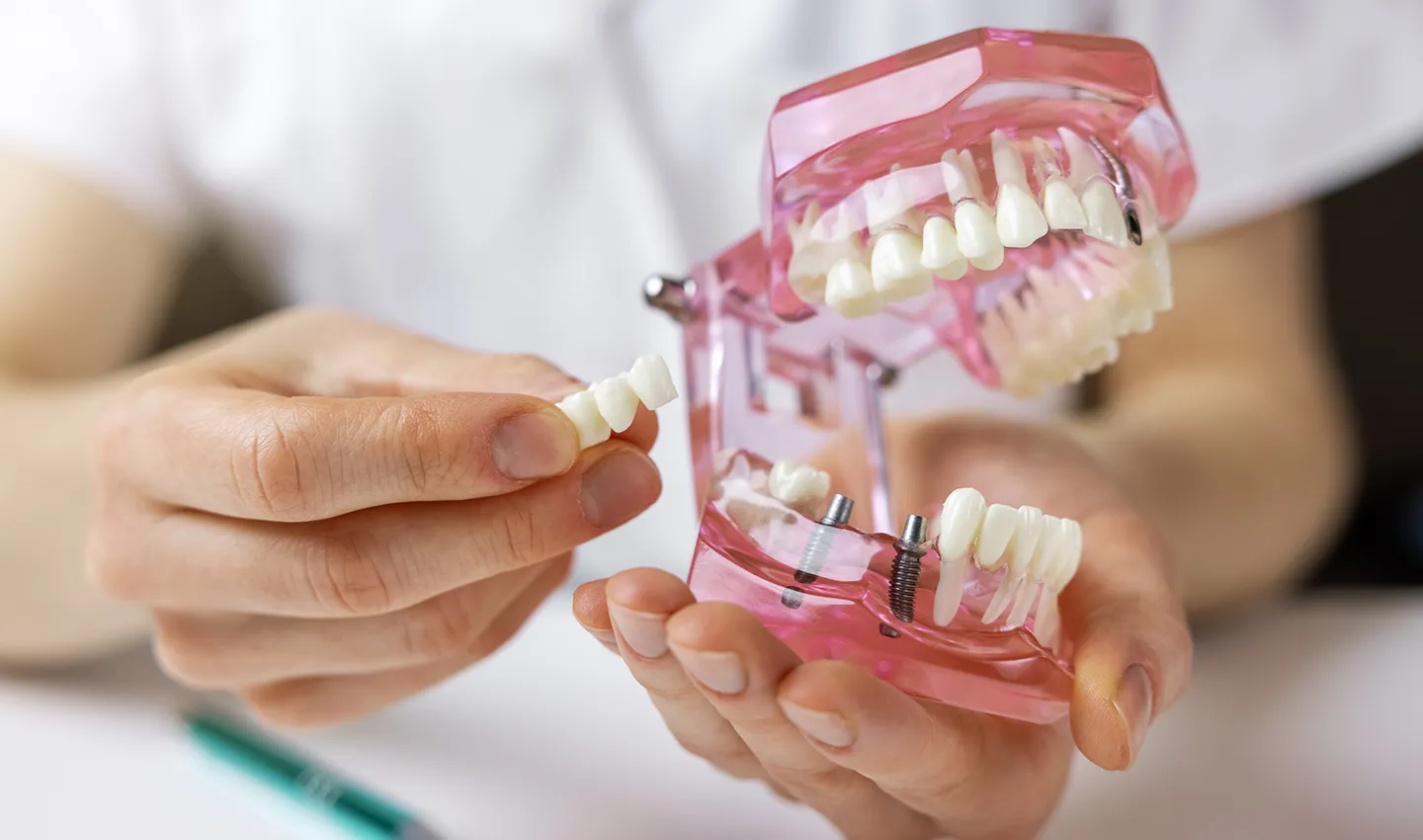 Dentist Showing How Dental Implants Work