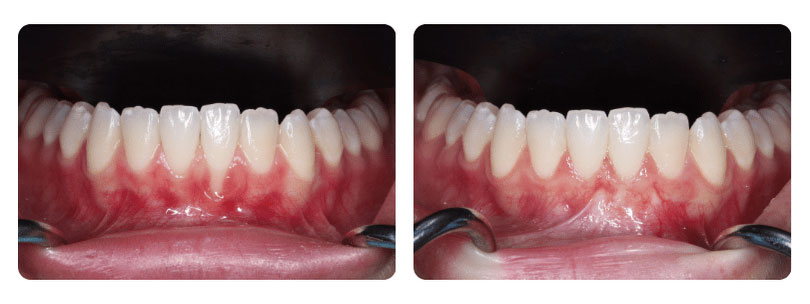 Gum Graft Patient 1