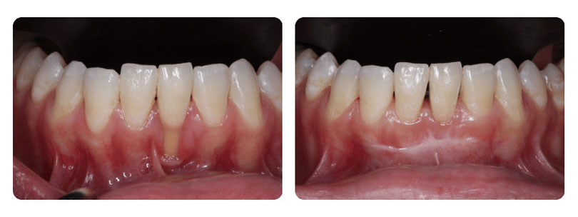 Gum Graft Patient 2
