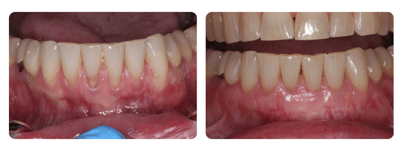 Gum Graft Patient 3