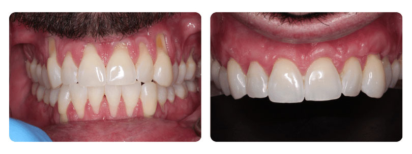 Gum Graft Patient 4