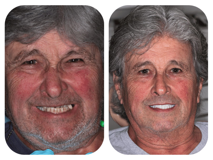 Smile Gallery Patient 1