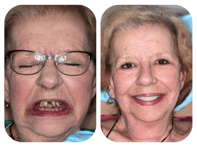 Smile Gallery Patient 2