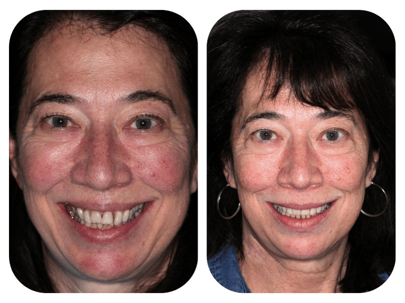 Smile Gallery Patient 3