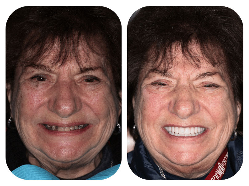 Smile Gallery Patient 4