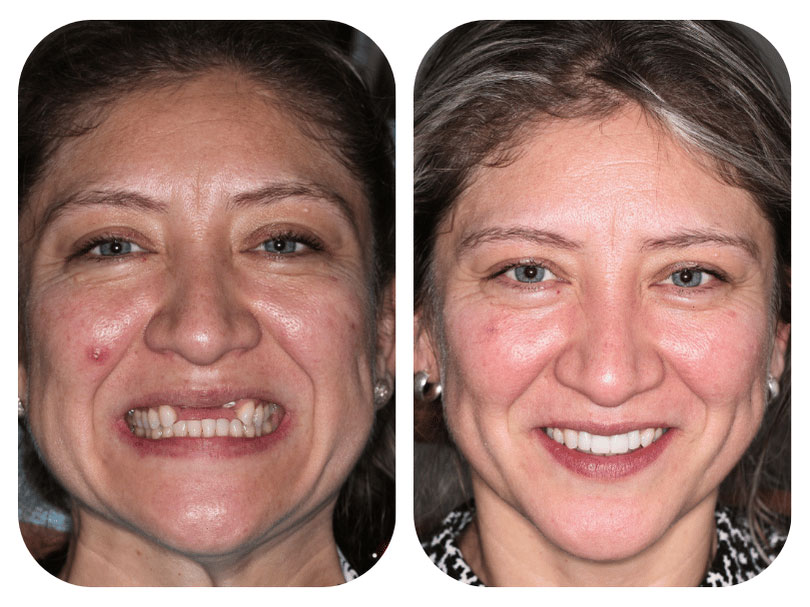 Smile Gallery Patient 5