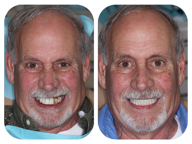 Smile Gallery Patient 6