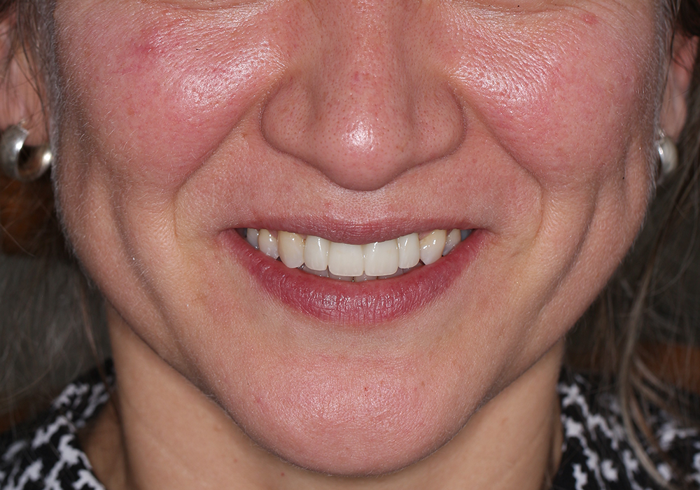 dental-implants-patient-after-1