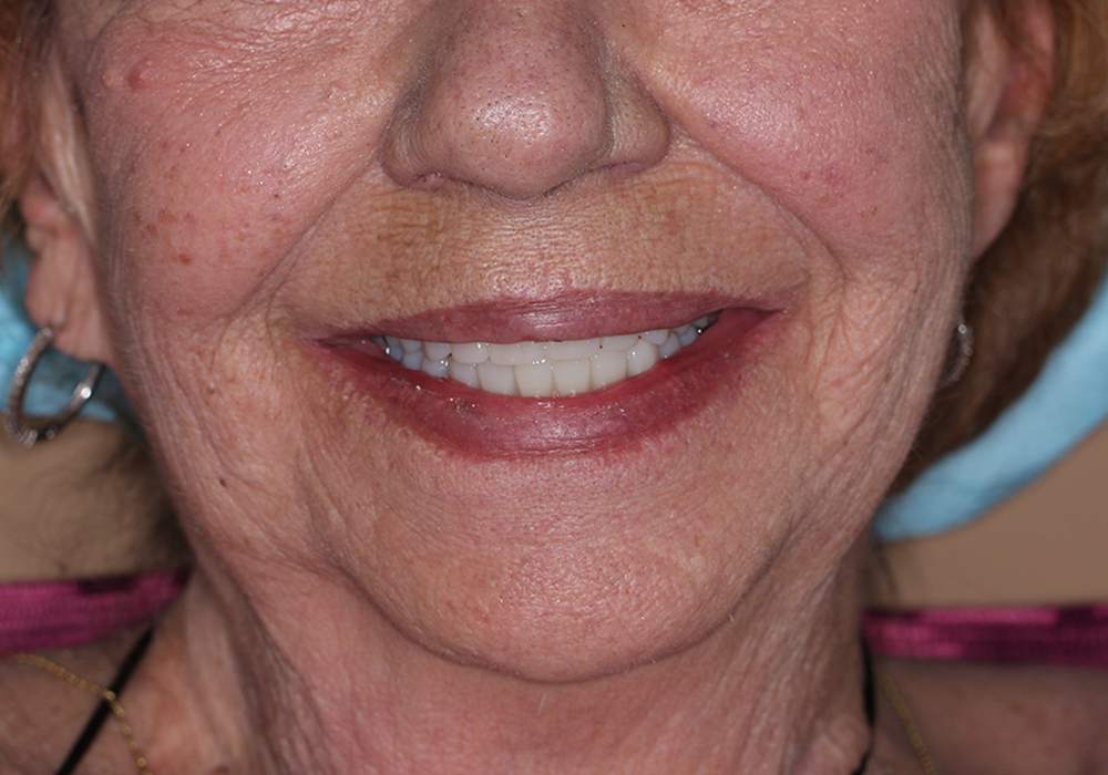 Dental Implants Patient After