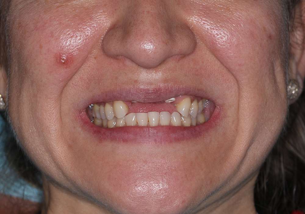 dental-implants-patient-before-1 dental-implants-patient-before-1
