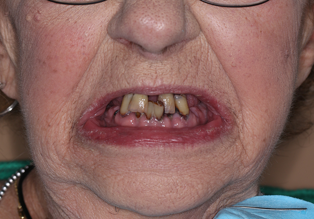 Dental Implants Patient Before